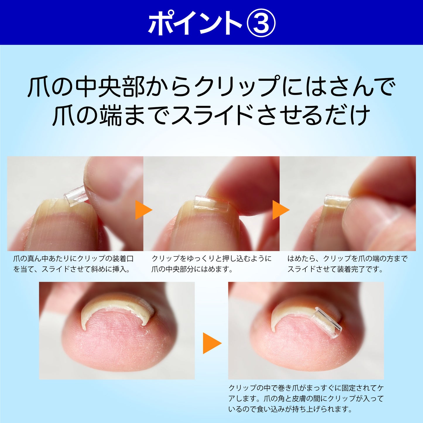 巻き爪クリスタルケア セットB(お得な5個入 軽度・中度用)