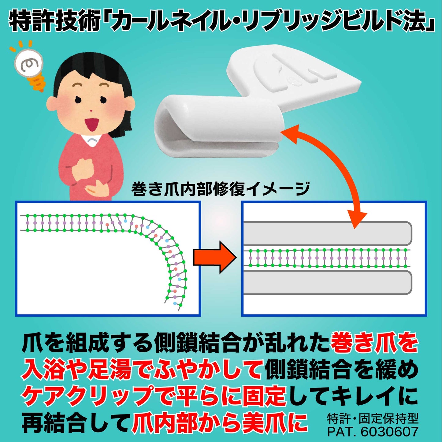 巻き爪クイックケア(軽度・中度の巻き爪用) カールネイル®クイックケアセット C-103