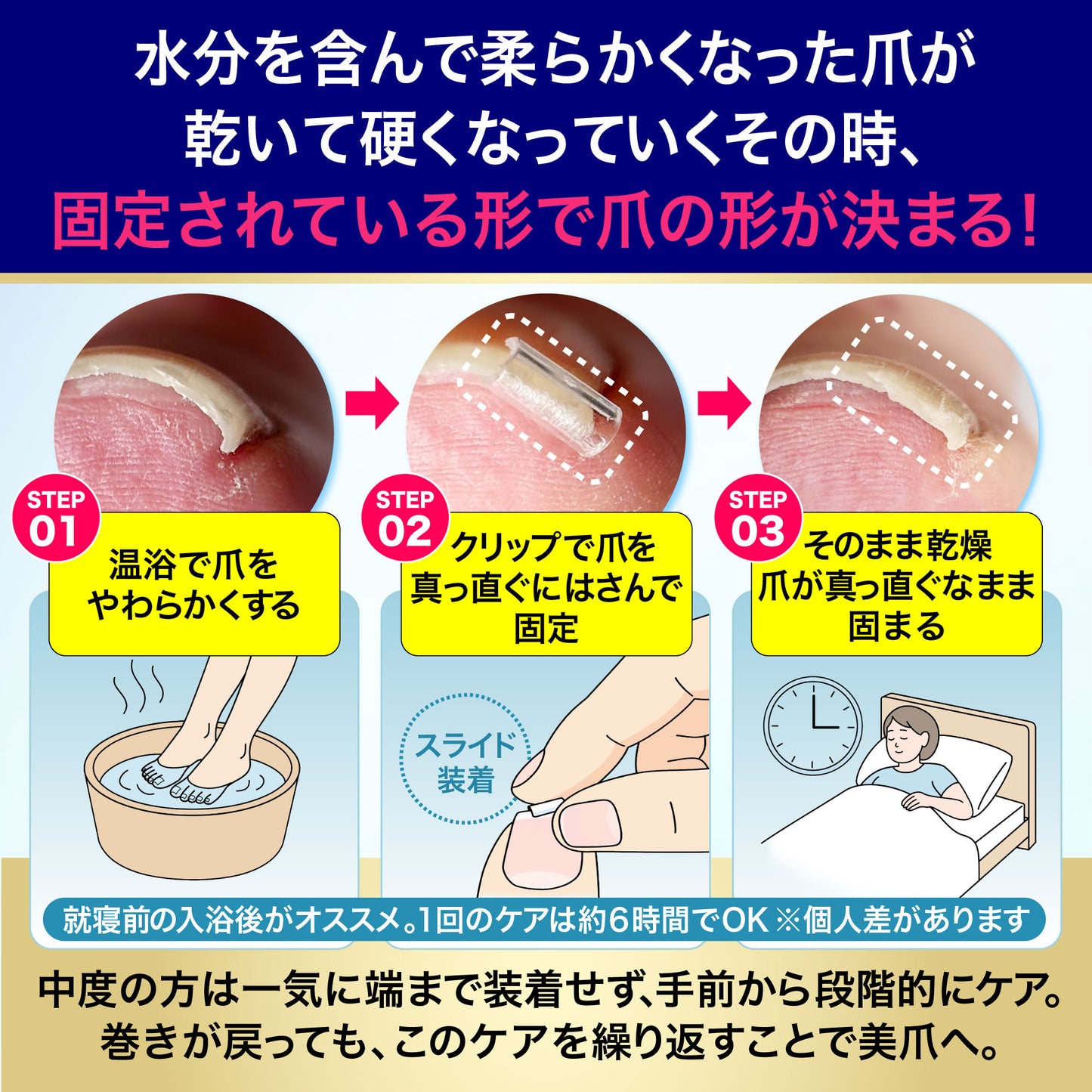 巻き爪もトゲも平らに固める【CURL NAIL 巻き爪クリスタルケア】日本製 巻き爪クリップ 自分で 自宅で ケア 痛くない まきづめ まきずめ setD(軽度・中度用 白1個入)
