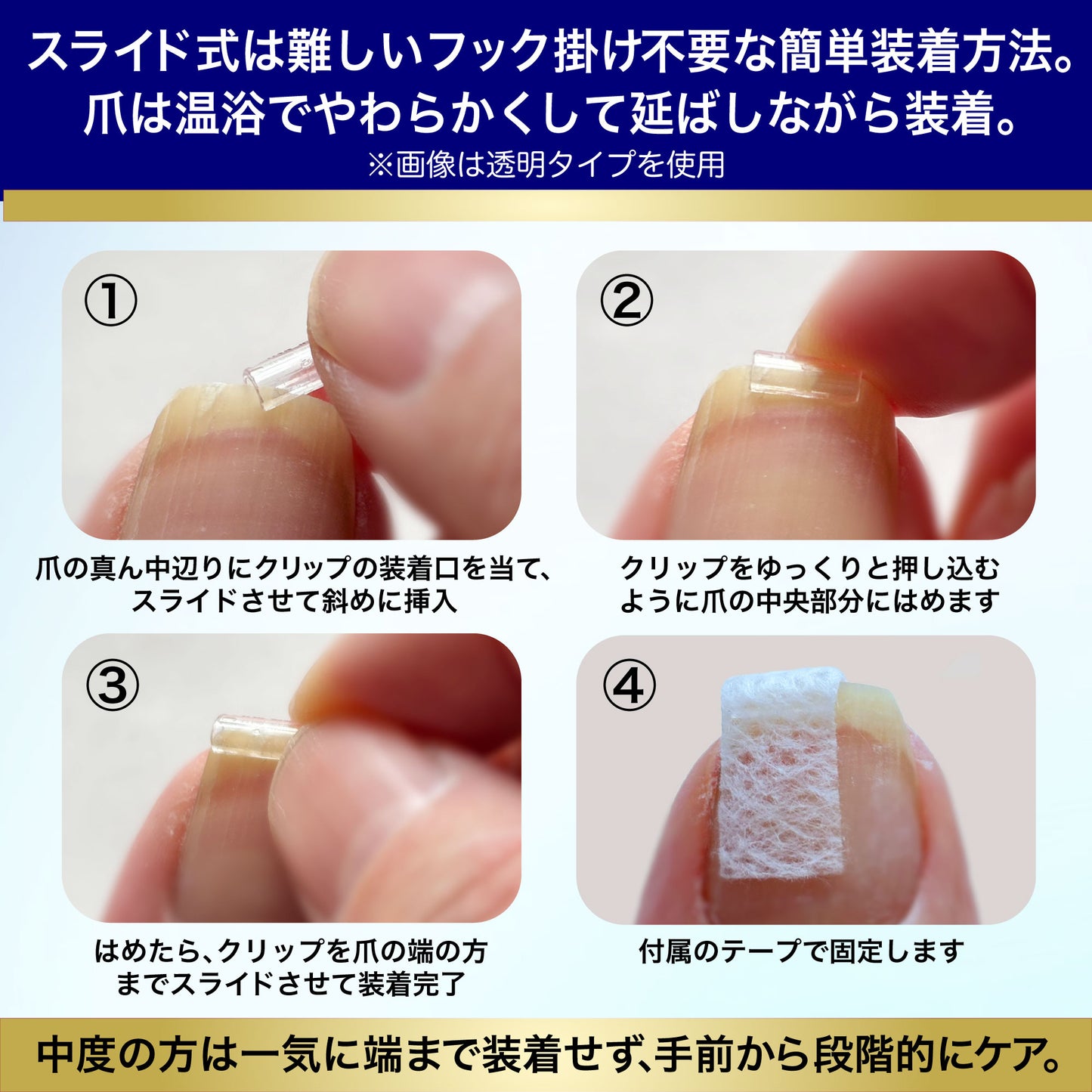 巻き爪もトゲも平らに固める【CURL NAIL 巻き爪クリスタルケア】日本製 巻き爪クリップ 自分で 自宅で ケア 痛くない まきづめ まきずめ setD(軽度・中度用 白1個入)